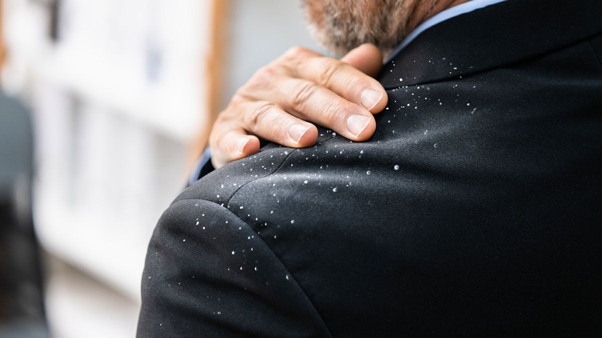dandruff-1-2023